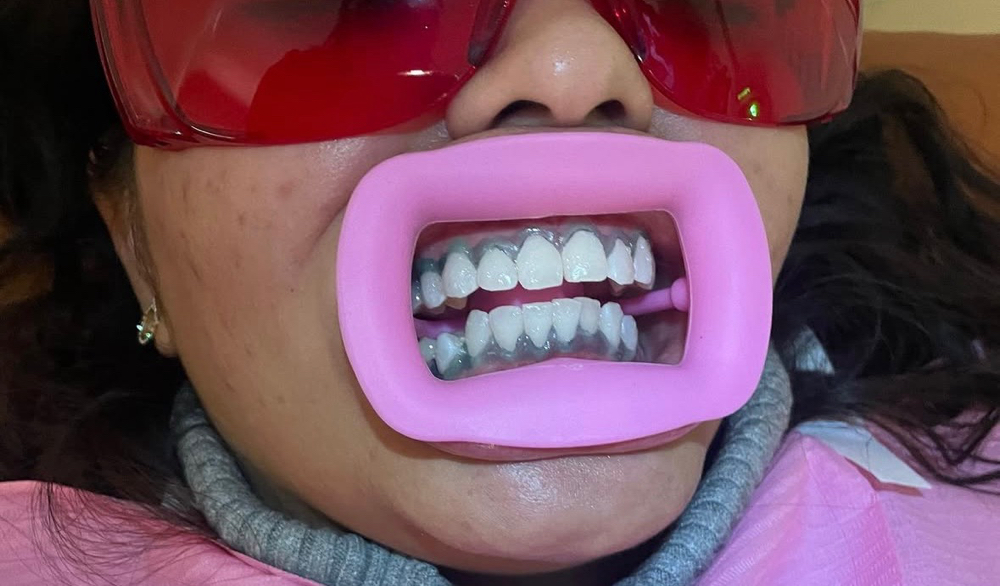 Teeth Whitening