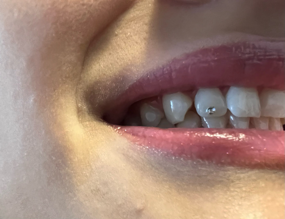 1 Tooth Gem