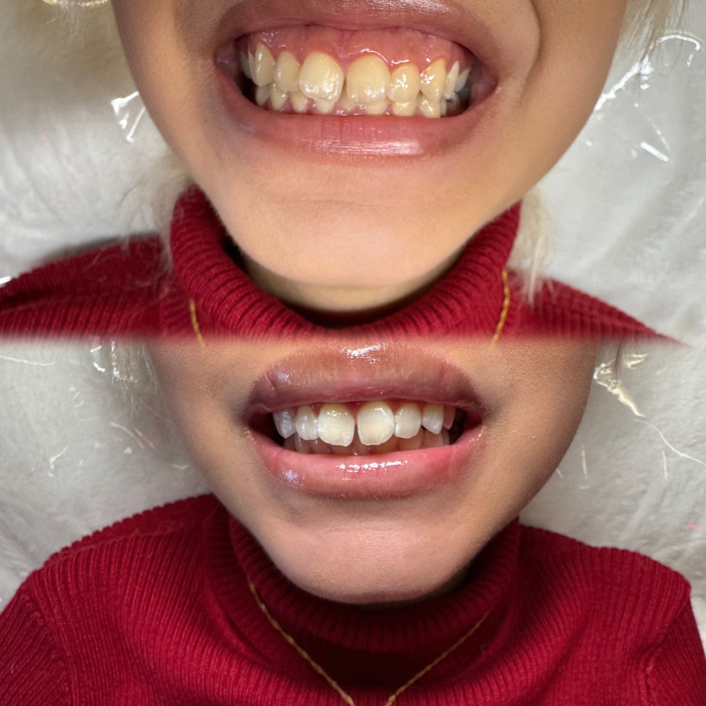 Teeth Whitening Touch Up