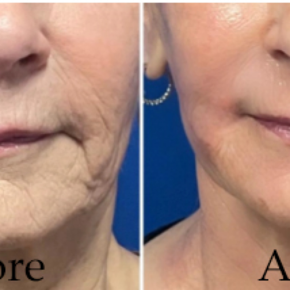 Vitti-Pure Skin Rejuvenation Add On at Cedar & Sage Aesthetics & Wellness in Hiawassee, GA