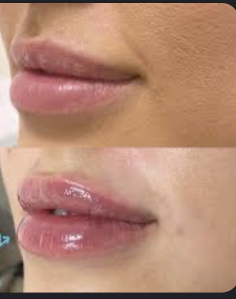 Lip Filler