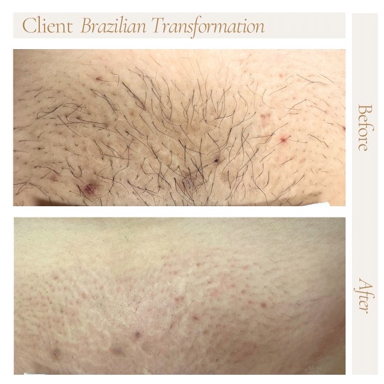 Brazilian Wax