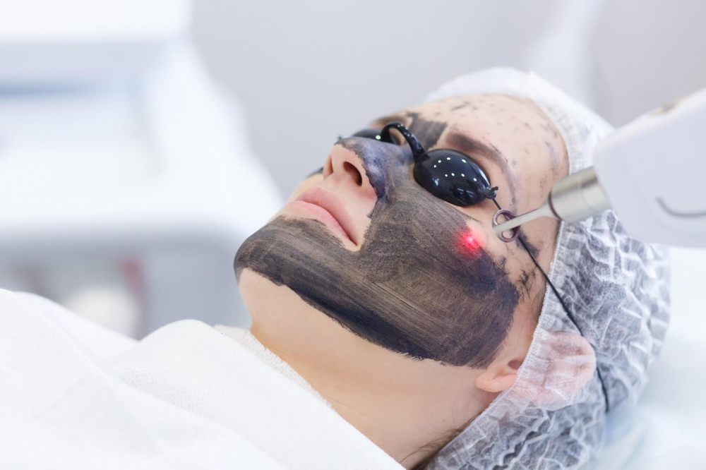 Carbon Facial