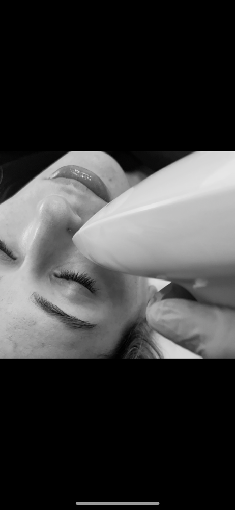 Nano-Fractional RF Skin Resurfacing