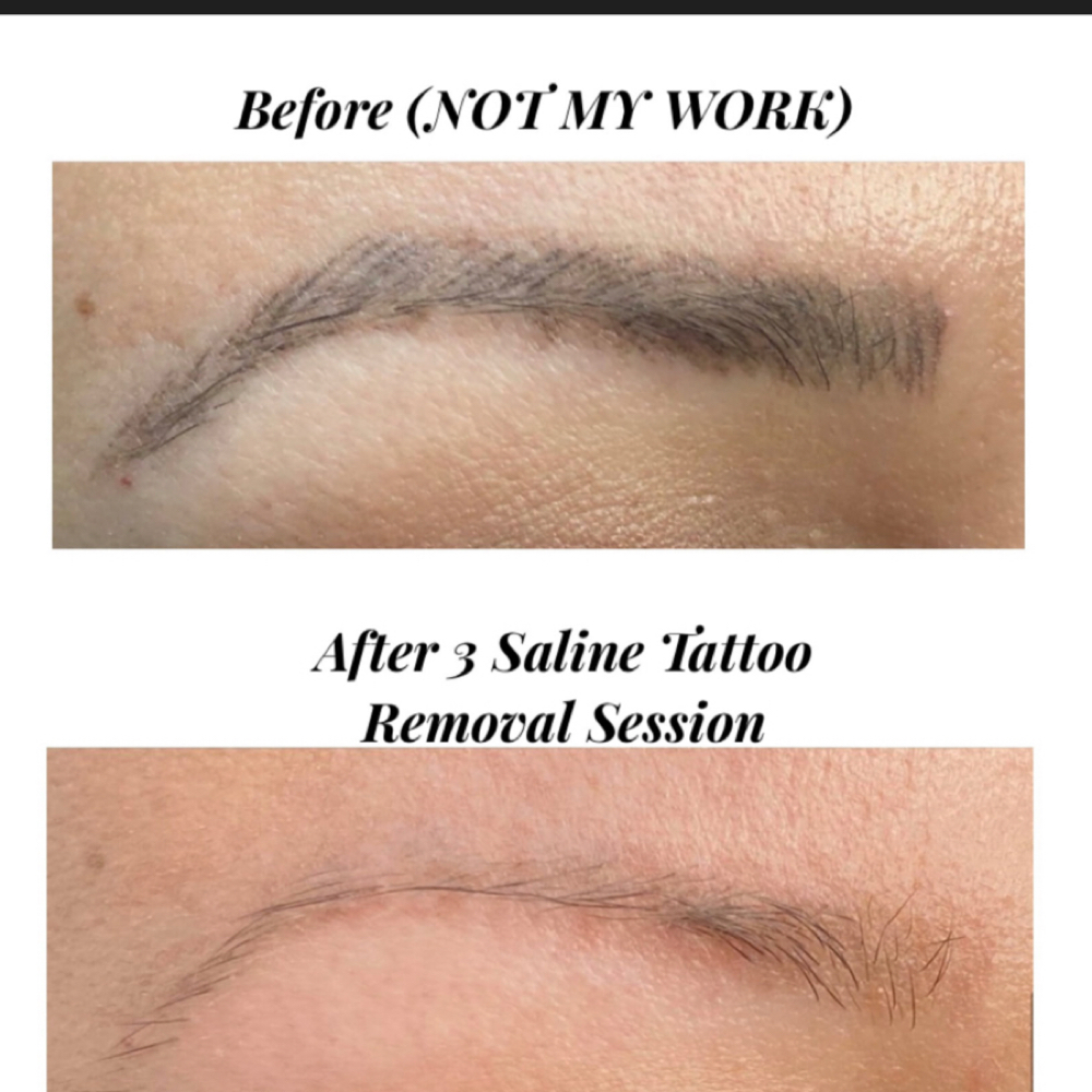 Saline Removal at Brows by Lissette in Fishers, IN