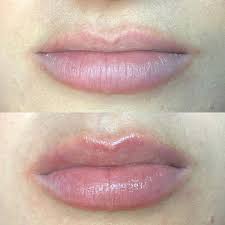 Hydrofacial Perk Lip Treatment