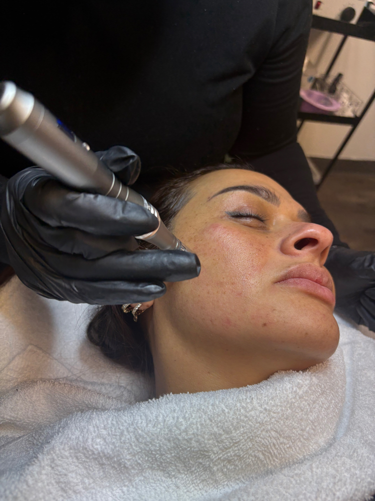 Microneedling PDRN of Salmon at Glowing Beauty By Ale in Dallas, TX
