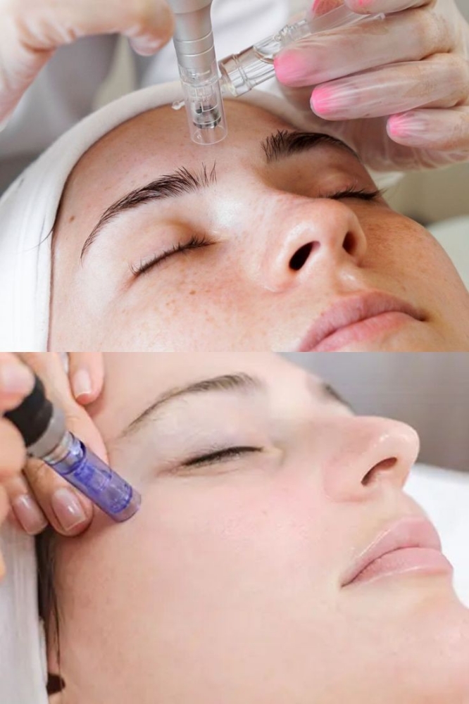 Dermaplaning & Nanoneedling Combo