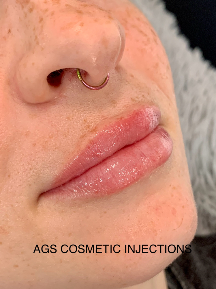 1/2 Syringe Lip Filler