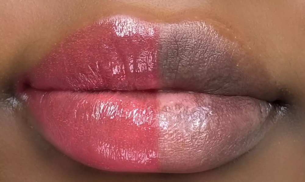 Dark Lip Neutralization First Session