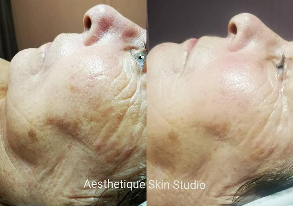 Get Glowing Micropeel