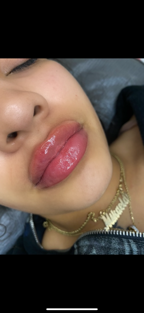 Lip Filler 2.5ml