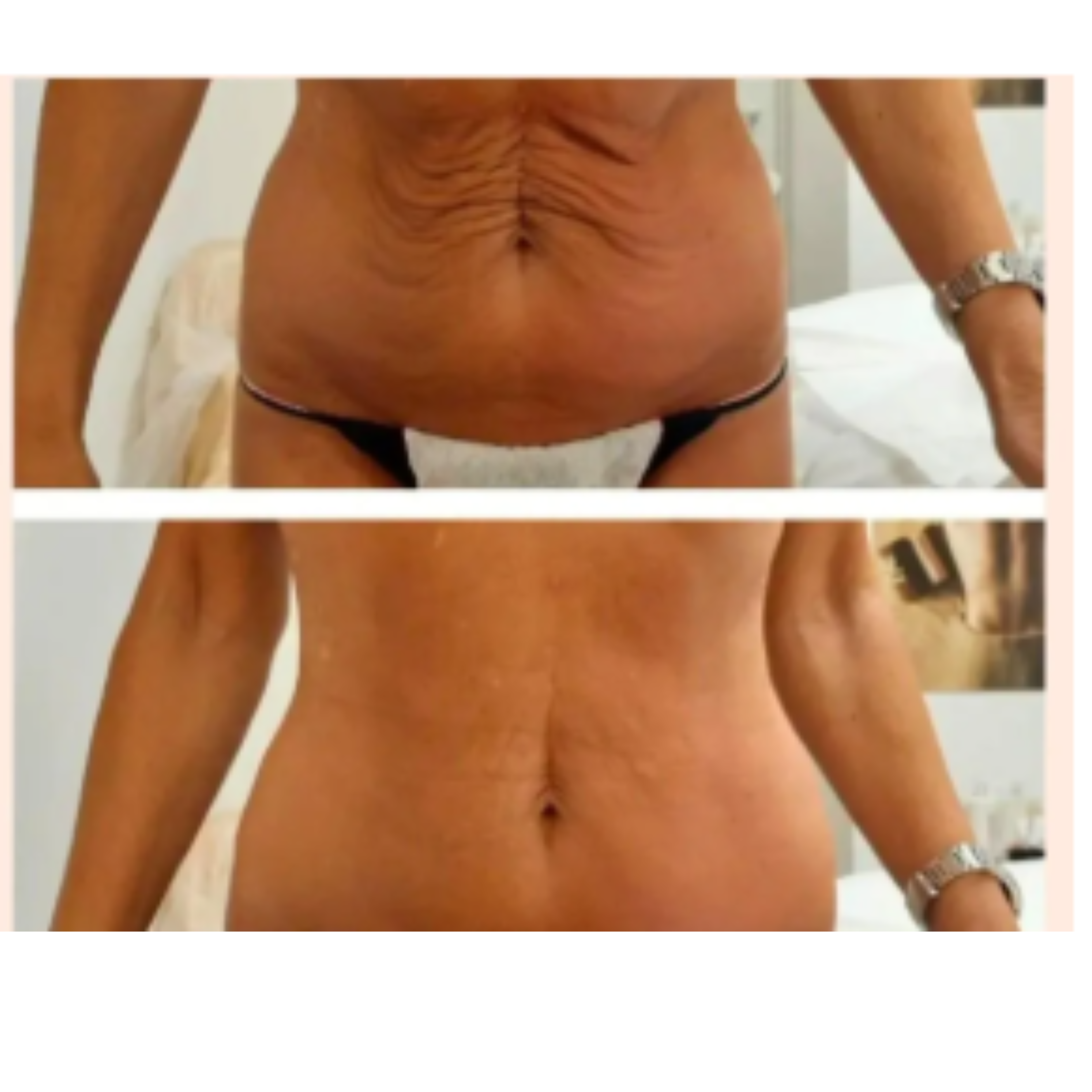 PROMO Tighten & Tone Transformation at Josephs Rejuvenation Center in Snellville, GA
