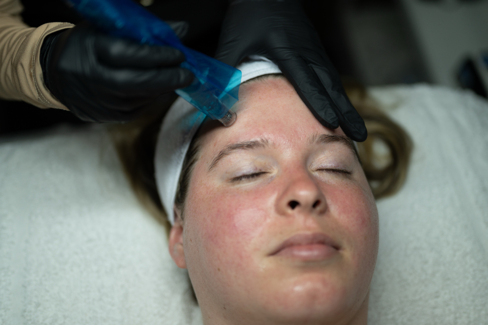 3 Sessions Of Microneedling(Face)