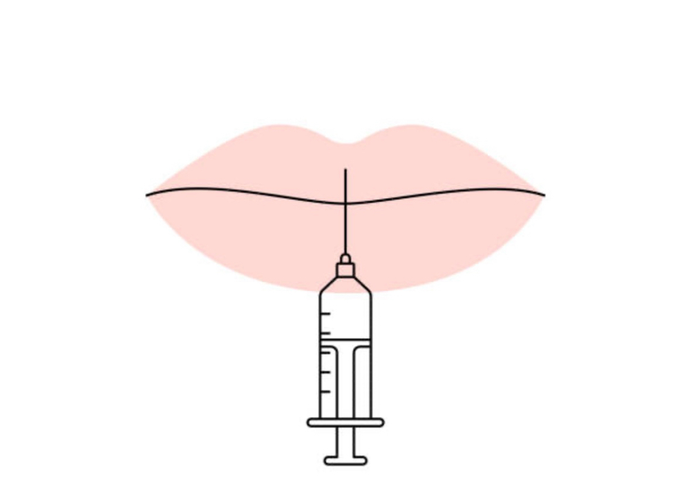 Lip Filler