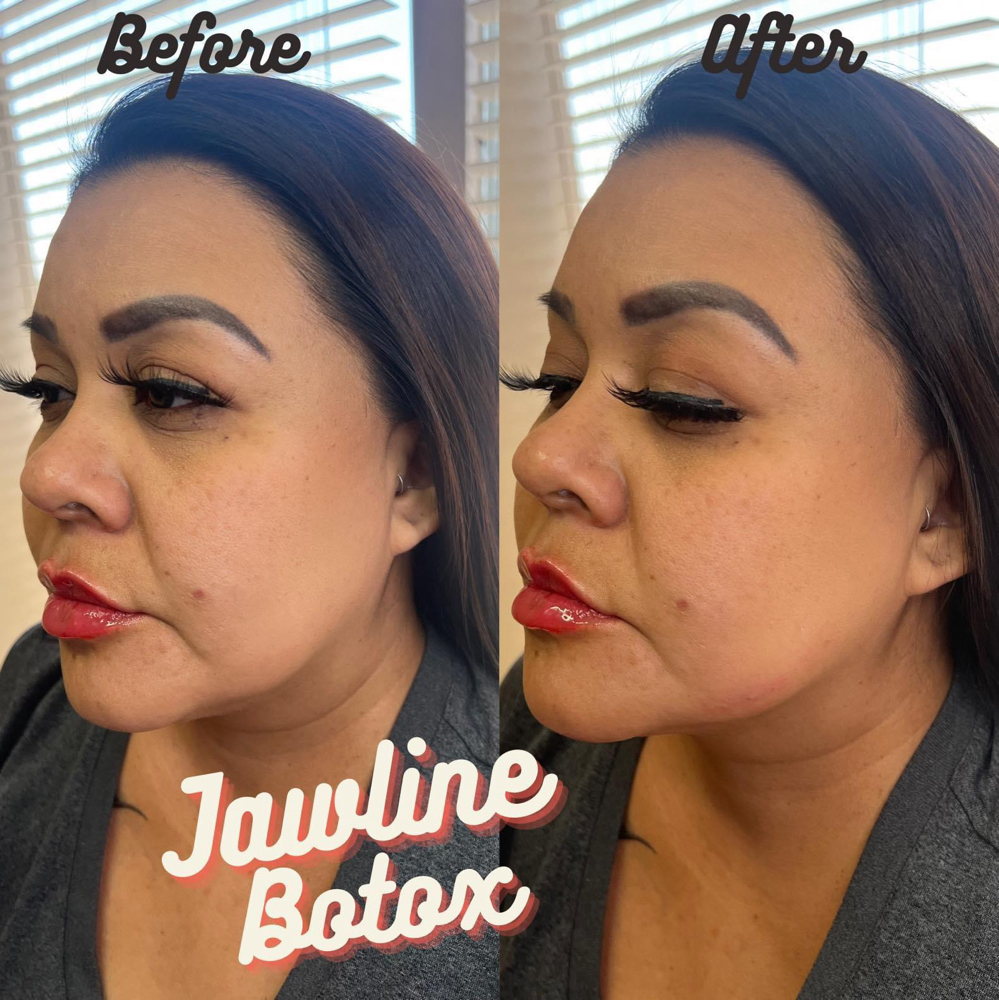 Tox-Jawline💉 at BeautyHolic Aesthetics LLC in Lubbock, TX
