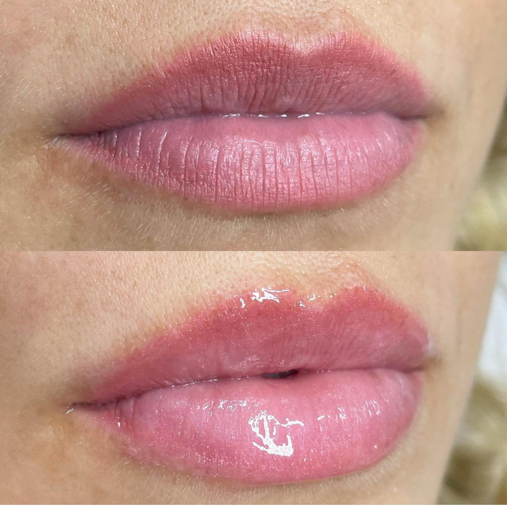 Hyagloss Lip Treament