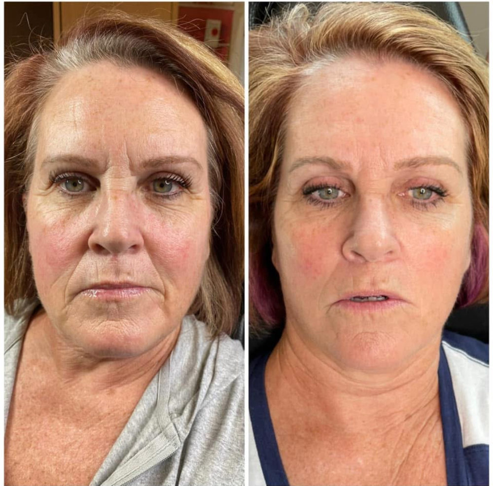 Anti Wrinkle Facial