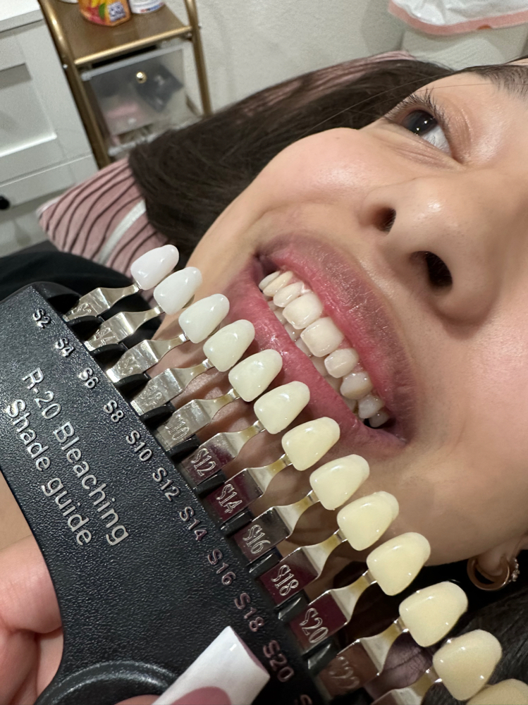 Teeth whitening✨ 1hr