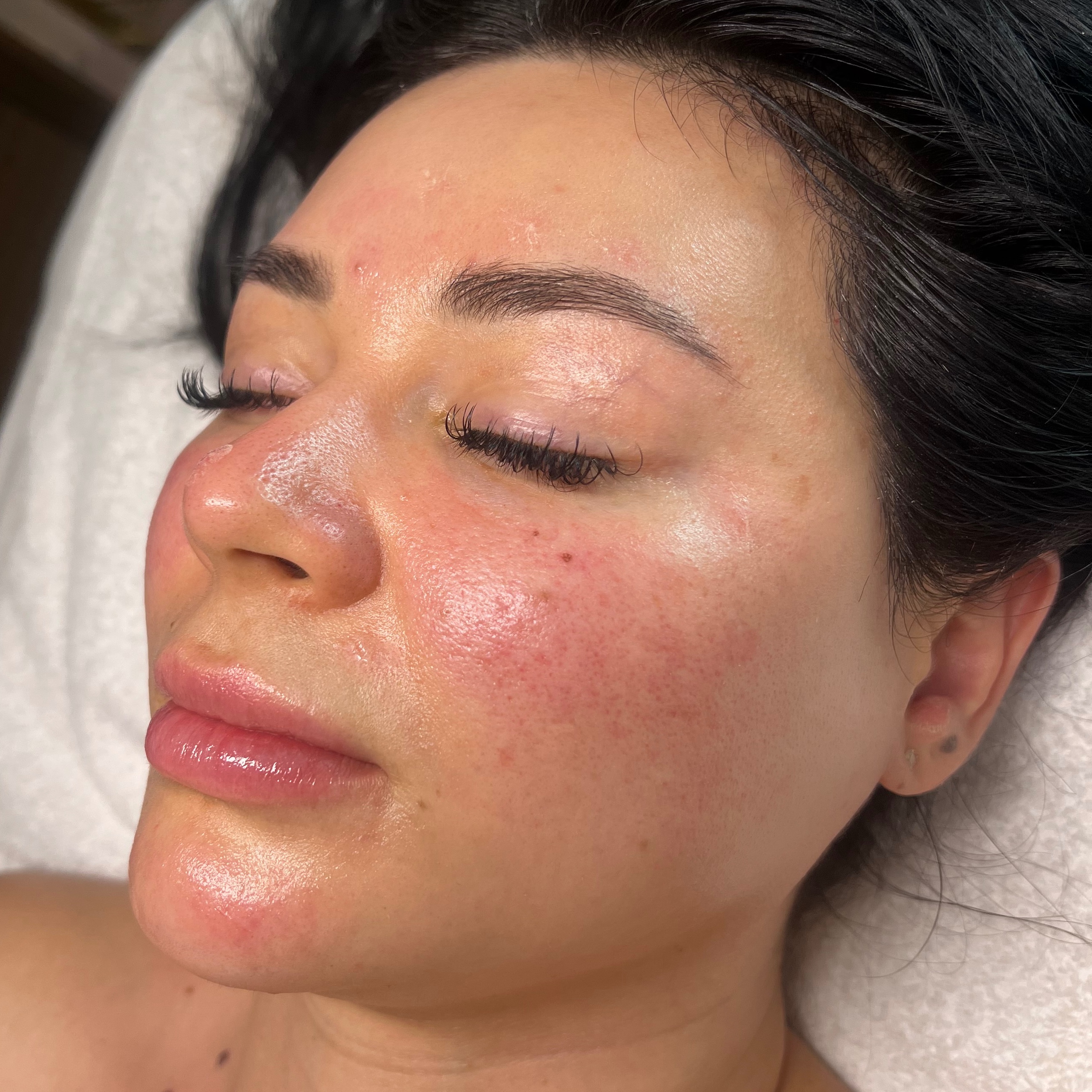 New Client at Martini Esthetics in Concord, CA