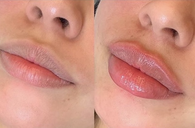 Hyaluronic Acid Lip Fillers