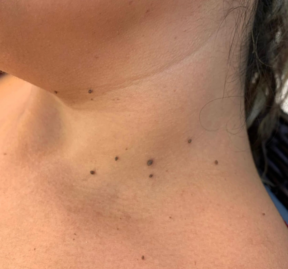 Skin Tags Removal