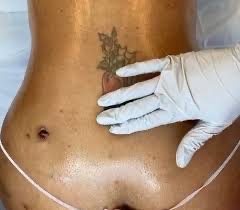 6 Post Op Lympatic Package💋