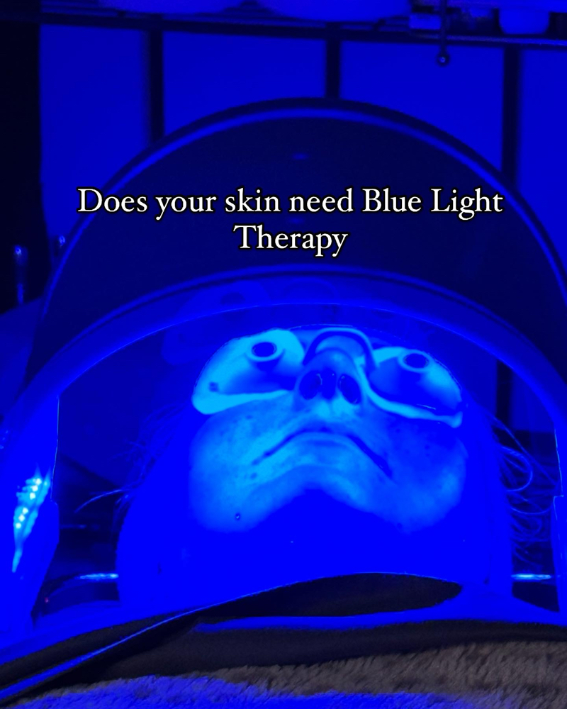 Acne Facial with Blue Light