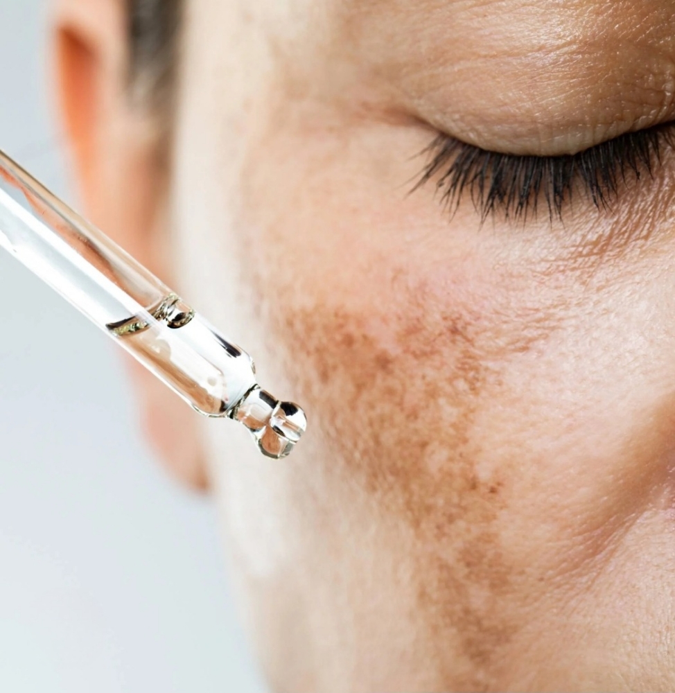 Hyperpigmentation