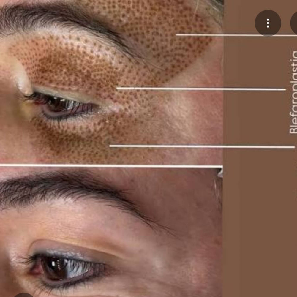 Fibroblast Eyelid Lift at Nenusk Aesthetics in Long Island City, NY