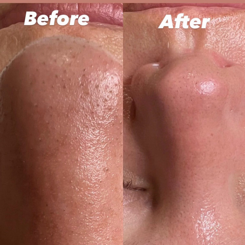 Platinum Hydrafacial at SKIN by Christine Russell in Green Bay, WI