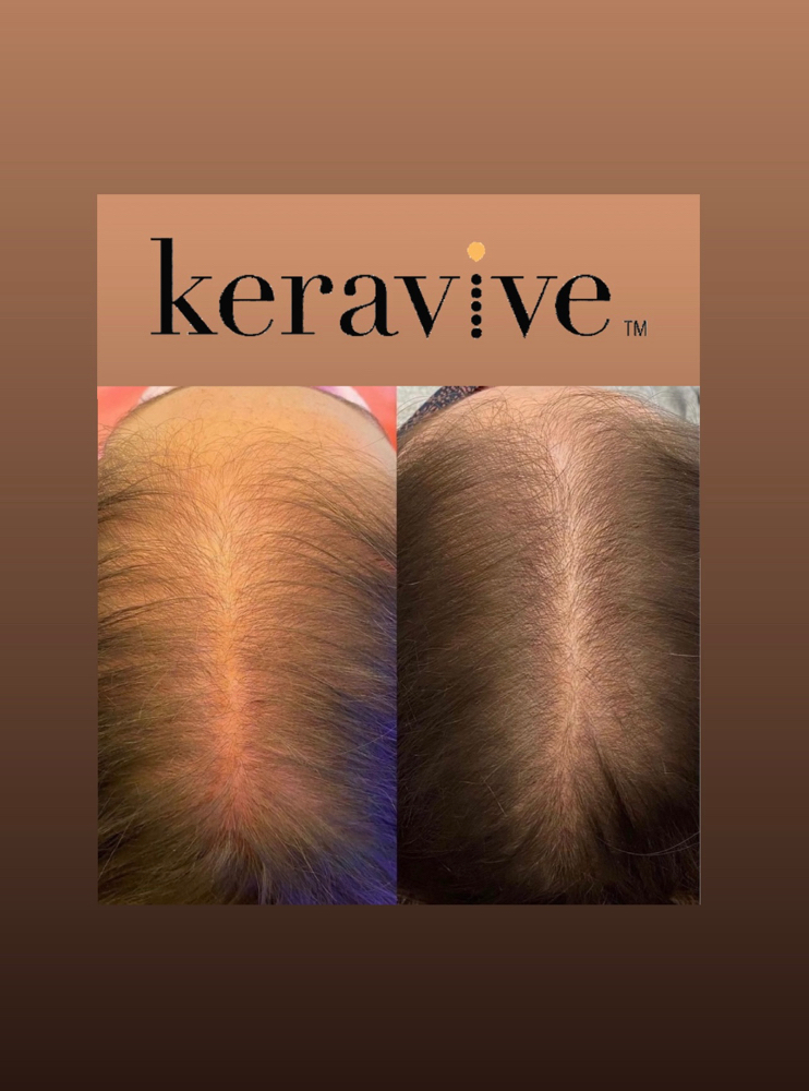 Keravive Scalp Treatment (Full)