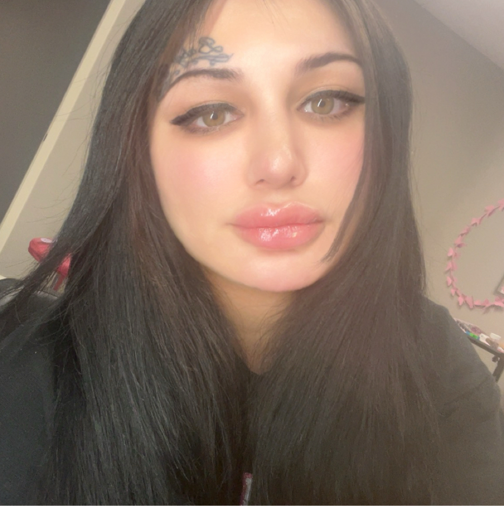 Lip Filler + Lip Flip Combo at Flawless Spa & Beauty in Fort Worth, TX