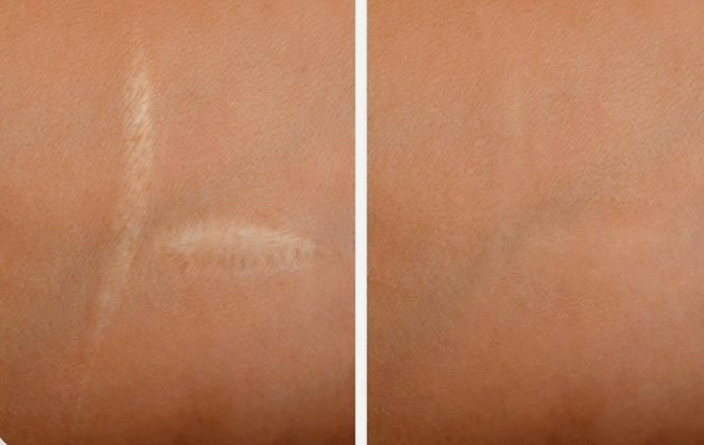 Inkless Scar Camouflage at Simply Snatched in Nevada, MO