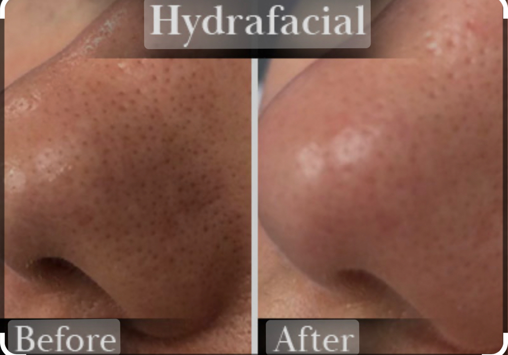 Mini Hydra Cleanse w/ Pore Removal