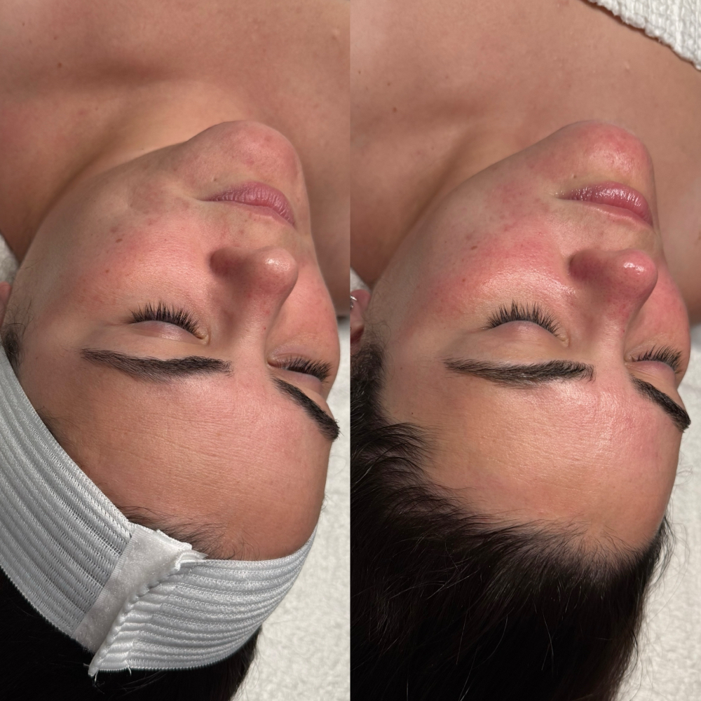 HD Signature Facial at EstheticsHD in Naples, FL