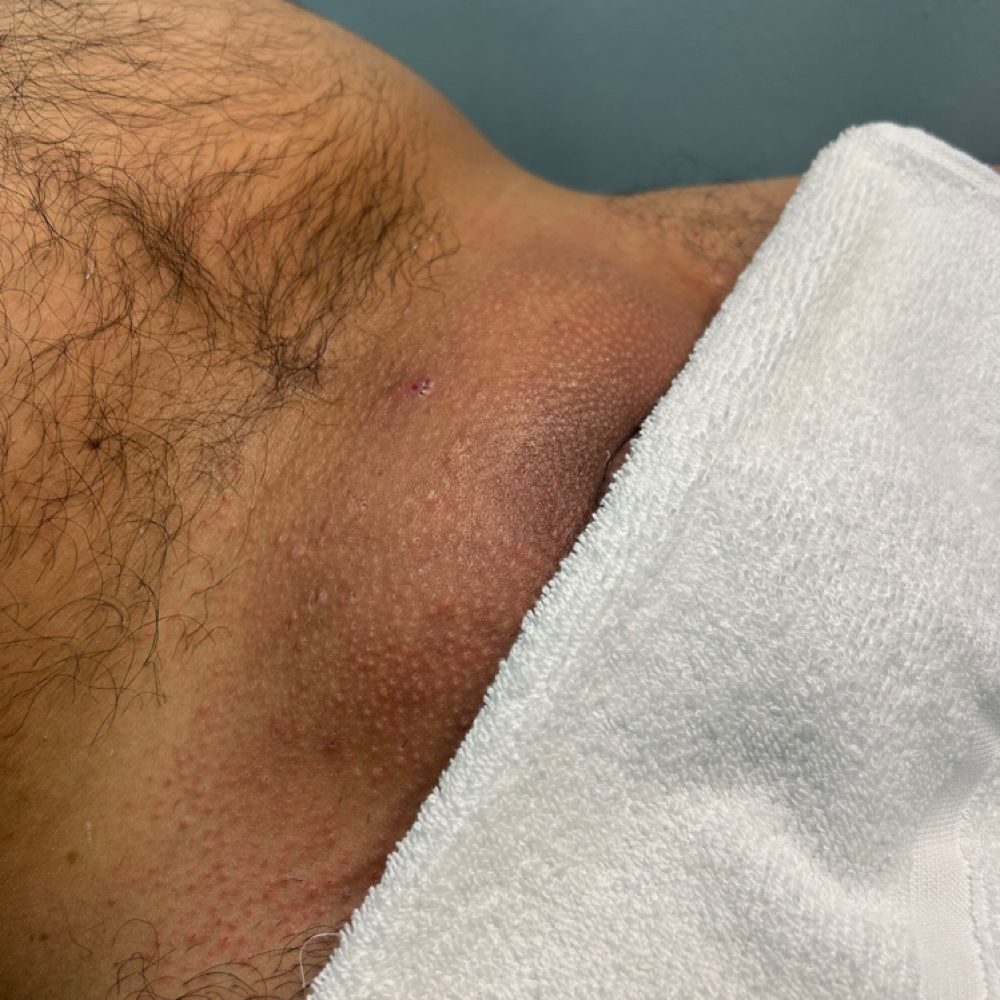 Male Brazilian at Eden’s Esthetics in Harlingen, TX