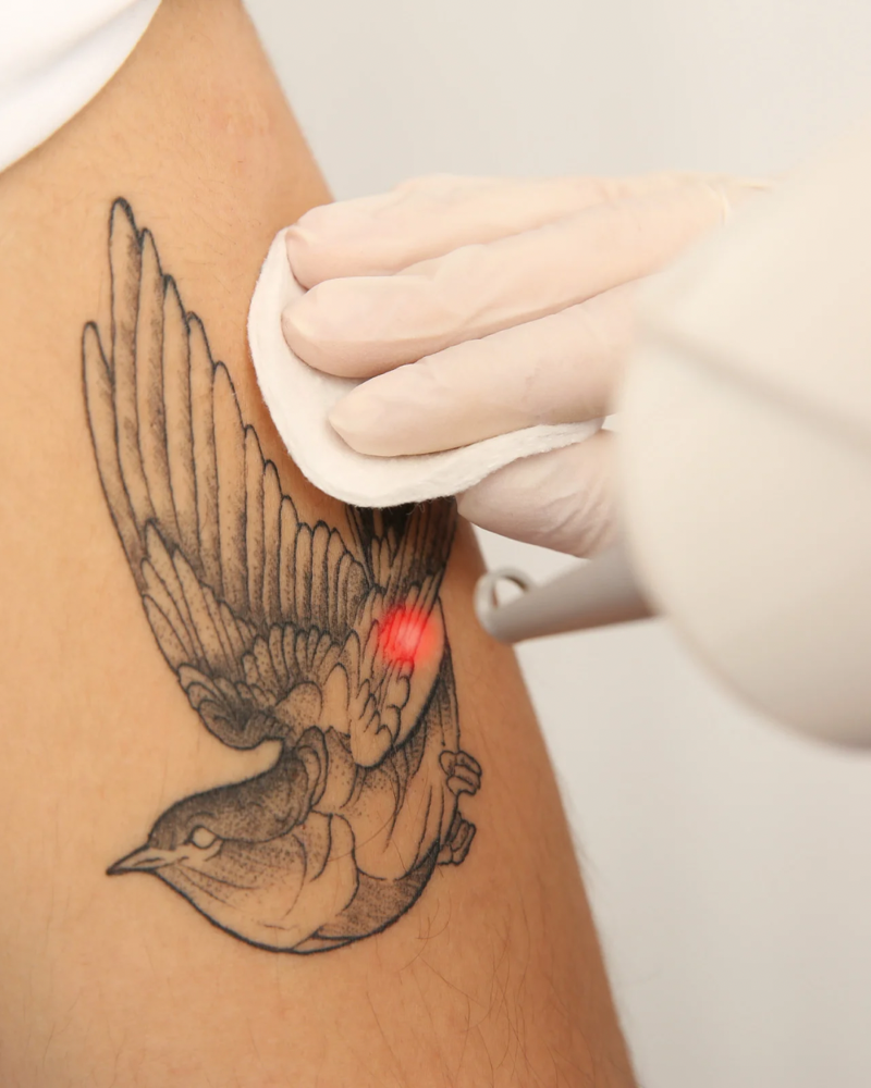 Laser Tattoo Removal Consultation at M.A.V Aesthetics in Fort Morgan, CO