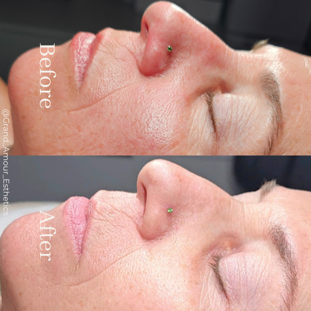Micro-needling Facial