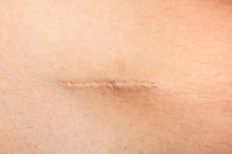 1 area of Scars ½ Inch-2 inches