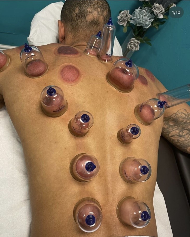 Back Cupping