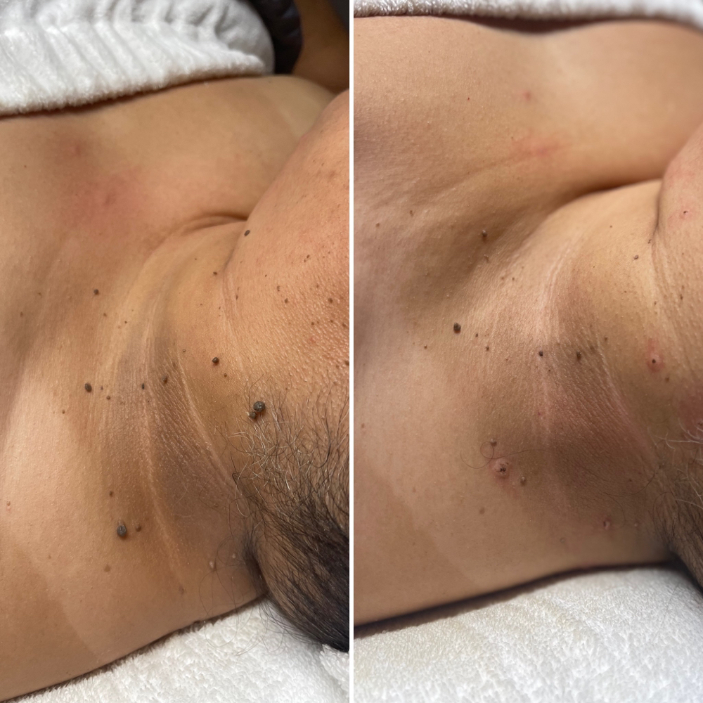 Mole/Lesion Removal