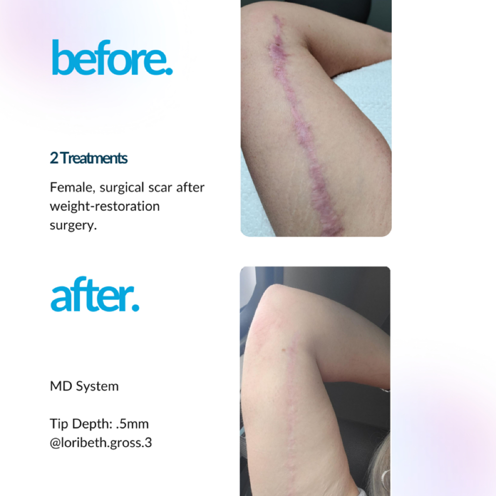 Procell Scar Tx-Consult Required at Alma Massage & Wellness in Wilmington, NC