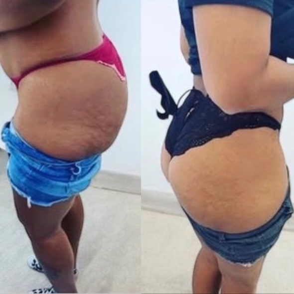 Laser Lipo or Cavitation+Butt Lift at Glo'Up Body Spa in Atlanta, GA