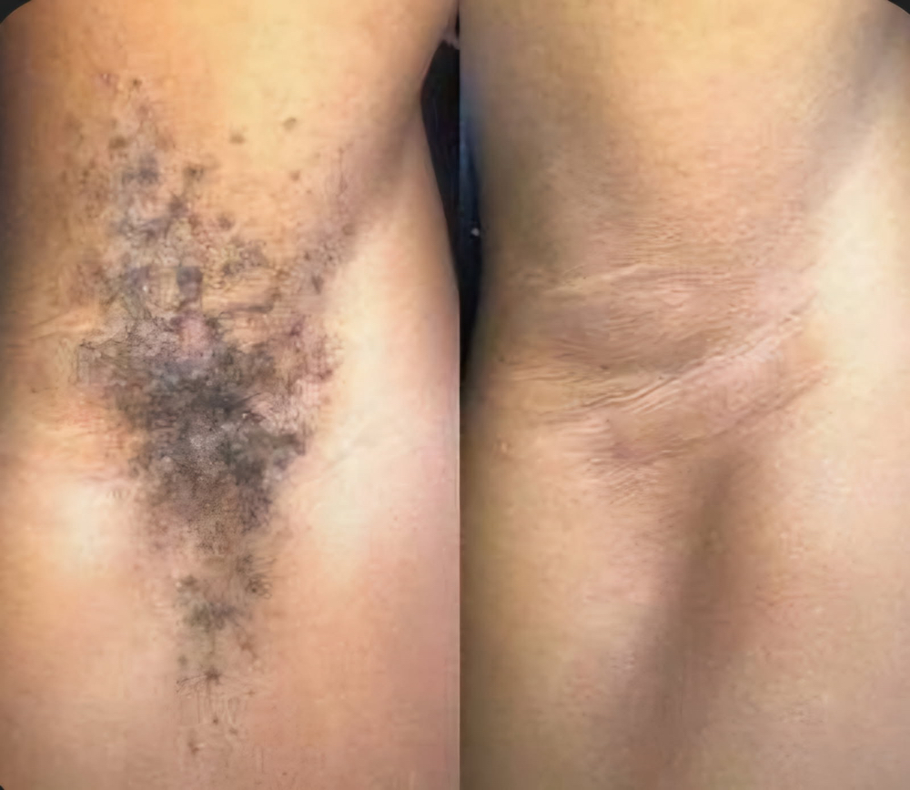 Underarm Hair Removal