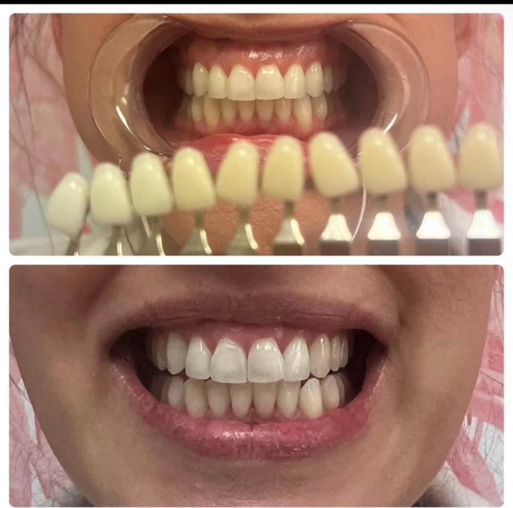 Cosmetic Teeth Whitening