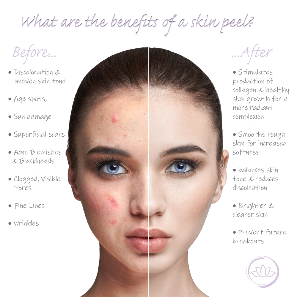 Facial and Chemical Peel