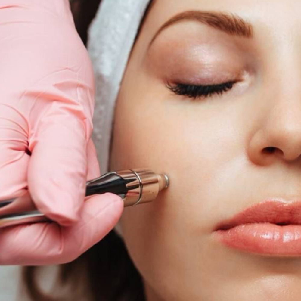 Microdermabrasion at Elevate Aesthetics in Sandy, UT