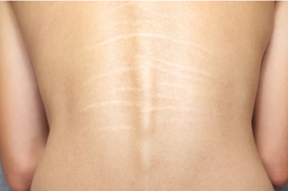 Upper Back Stretchmark Camouflage
