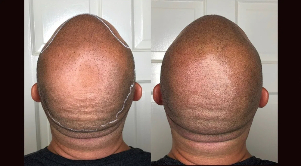 SMP ( Scalp Micropigmentation)